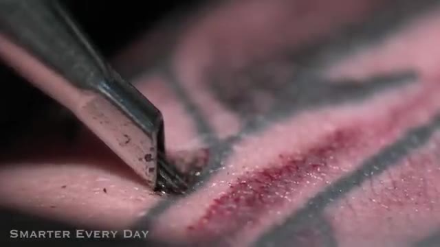 How Laser Tattoo Removal Works - Smarter Every Day 123
